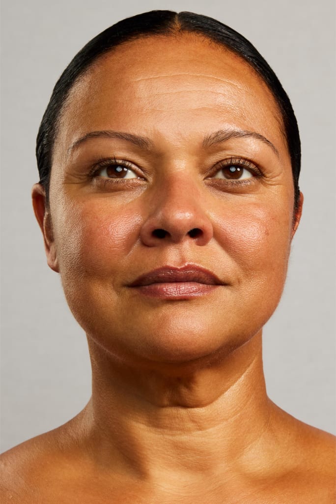 Patented device for estheticians combines exfoliation and peach fuzz removal with precision, safety, and clinical results after a single use