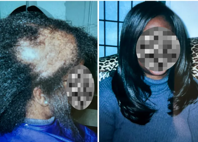 before and after of client with net method hair replacement