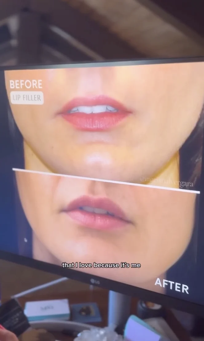 Before and After comparison of a Lip Filler