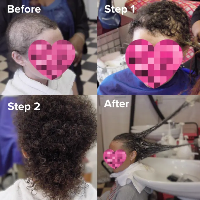 before and after of client with net method hair replacement