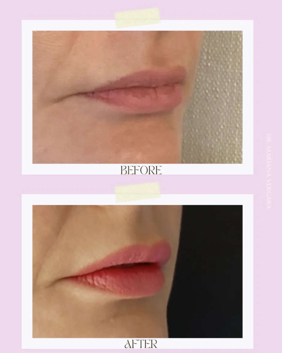 Before and After comparison of a Lip Flip