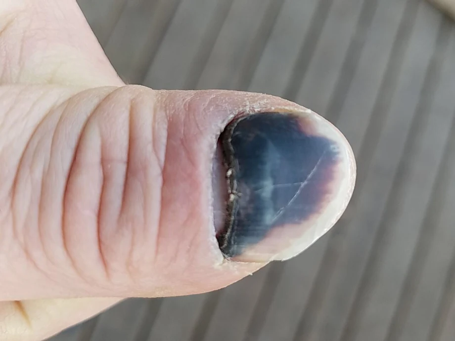 Documenting a Nail Regrowing